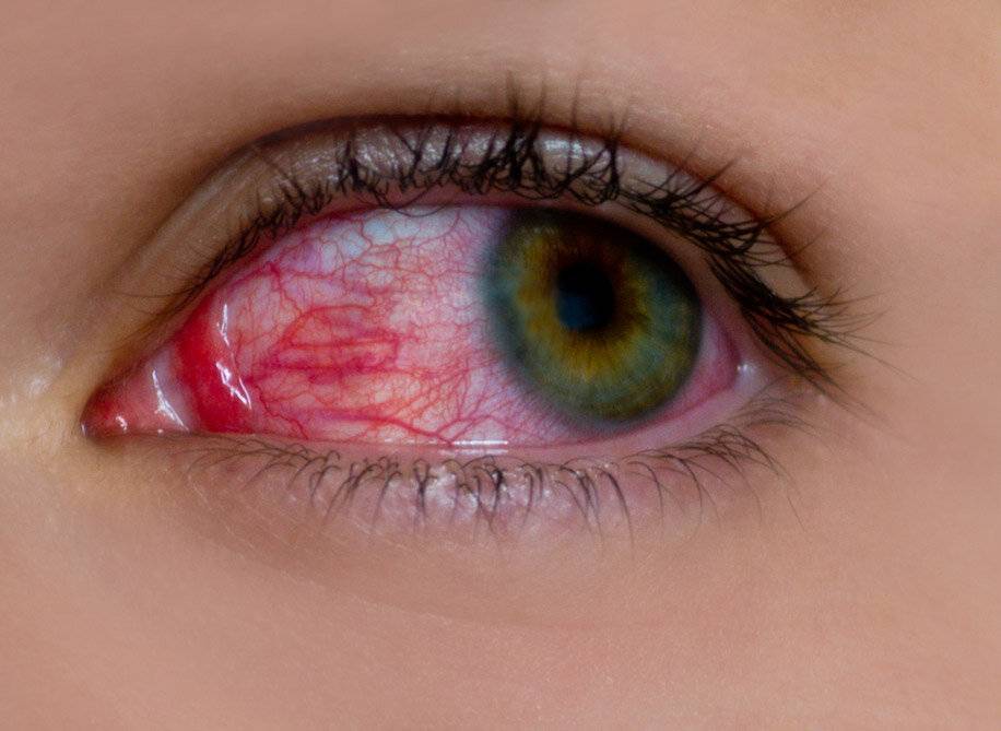 Красные глаза после линз: почему краснеют и болят оба или один, что делать, капли от покраснения при ношении изделий оптики
