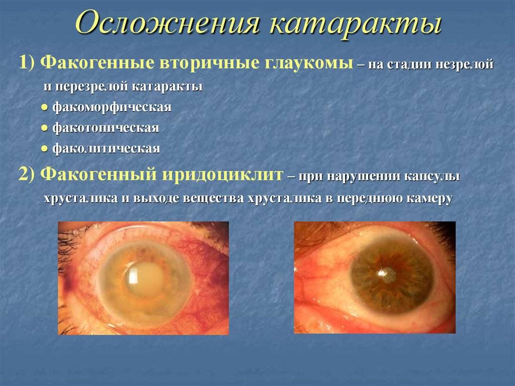 Хрусталик глаза: строение и функции | заболевания хрусталика