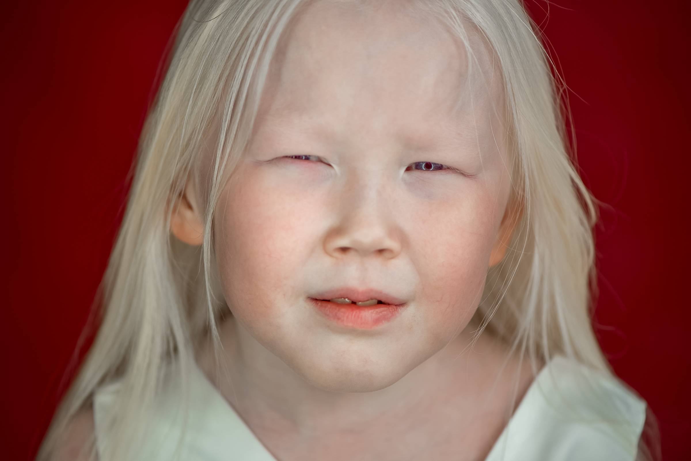 Глазокожный альбинизм: причины, симптомы, лечение - справочник болезней | медицина - информационно-познавательный портал