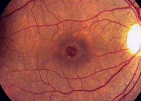 Чем обусловлен макулярный разрыв сетчатки глаза: все о симптомах и лечении патологии
