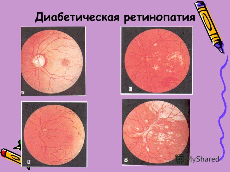 Диабетическая ретинопатия: что это такое, лечение, причины, симптомы, стадии, диагностика, профилактика, осложнения