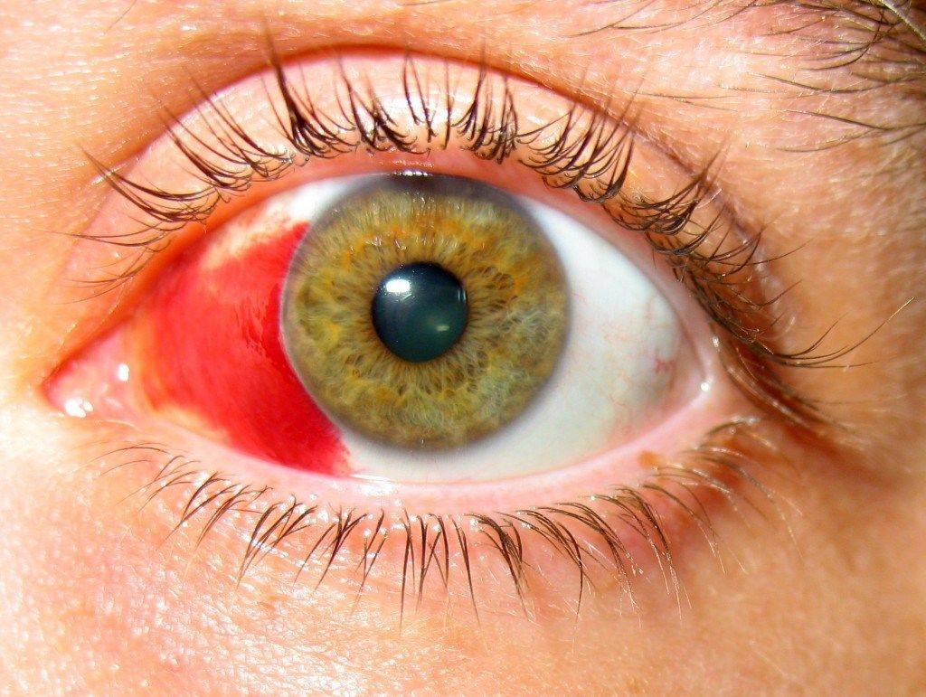 Гифема (кровоизлияние в переднюю камеру глаза): что это такое, симптомы, причины, лечение (капли и прочие средства), прогноз и другие аспекты - я здоров