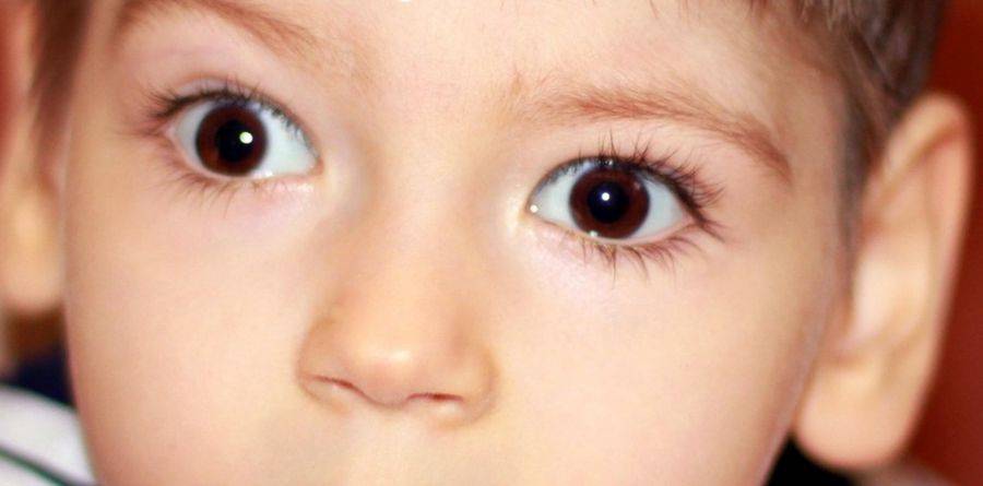 Врожденная глаукома у детей