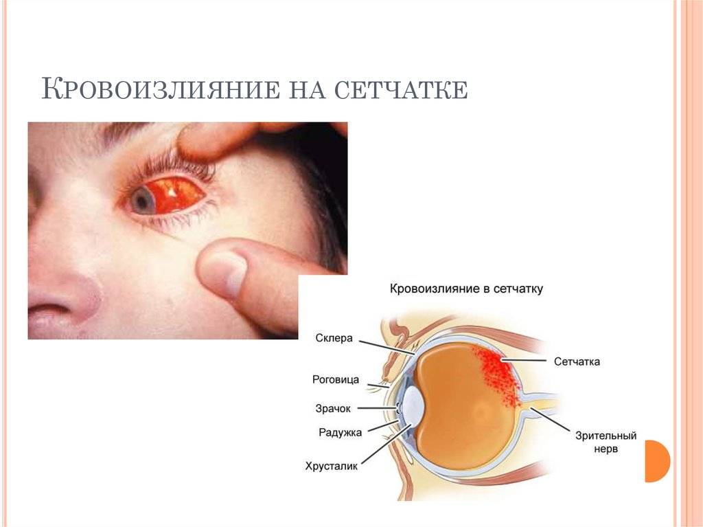Кровоизлияние в глаз, лечение (что делать), причины, симптомы, профилактика.