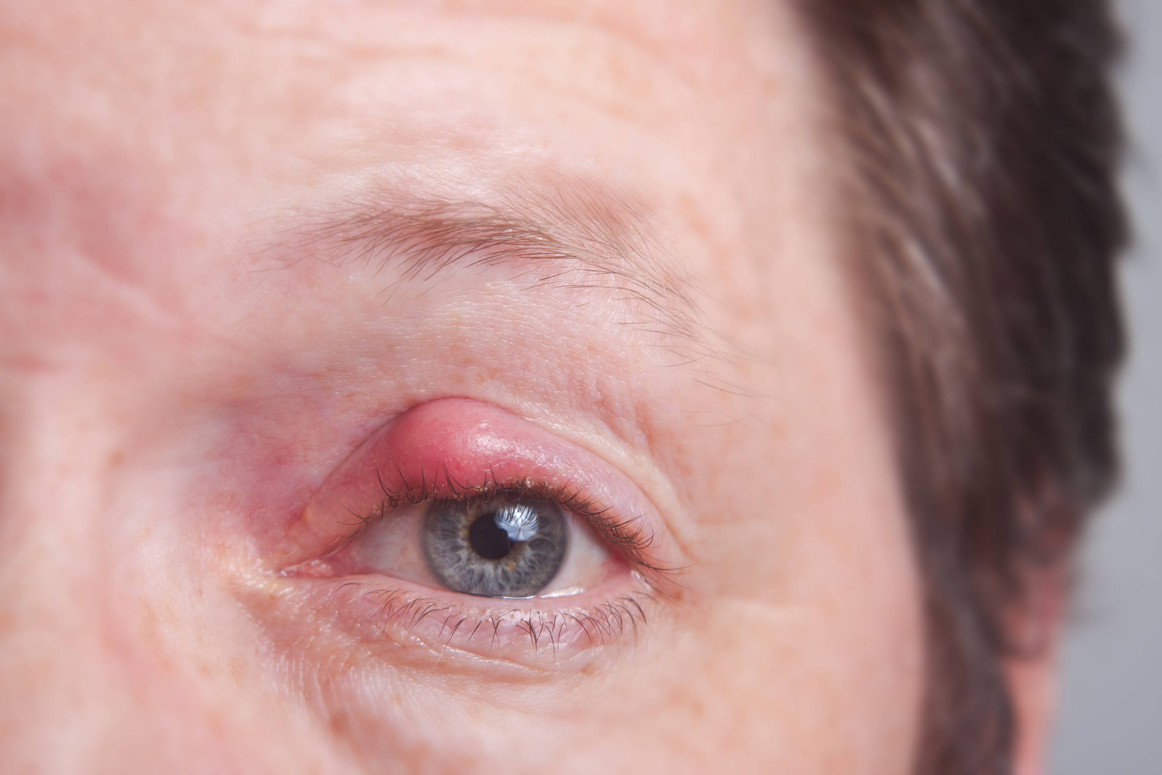 Болит глаз под верхним веком: причины, симптомы, лечение
