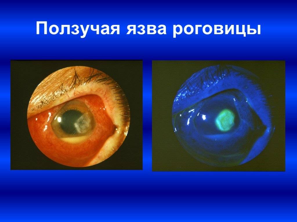 Язва роговицы глаза - что это, лечение, причины и симптомы
