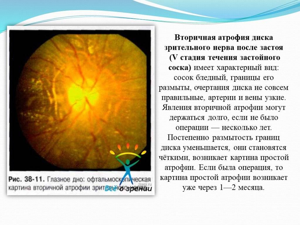 Развитие отёка зрительного нерва — информация, которую важно знать