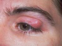 Причины появления синяка под глазом без удара и как его лечить