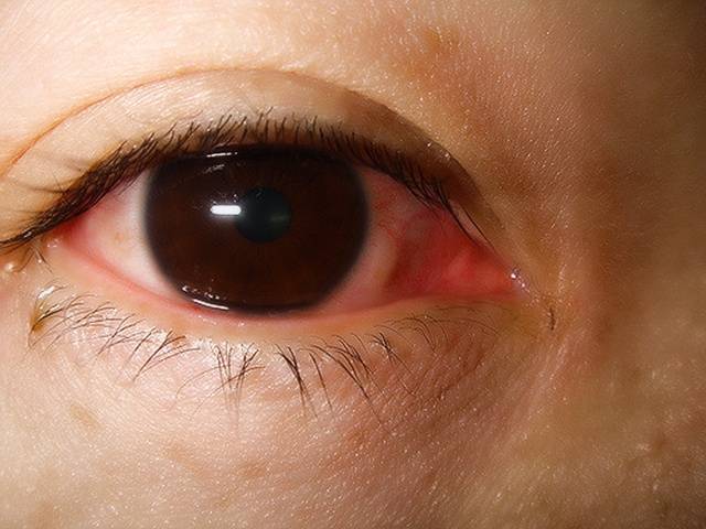 Щиплет глаза - причины, симптомы, лечение