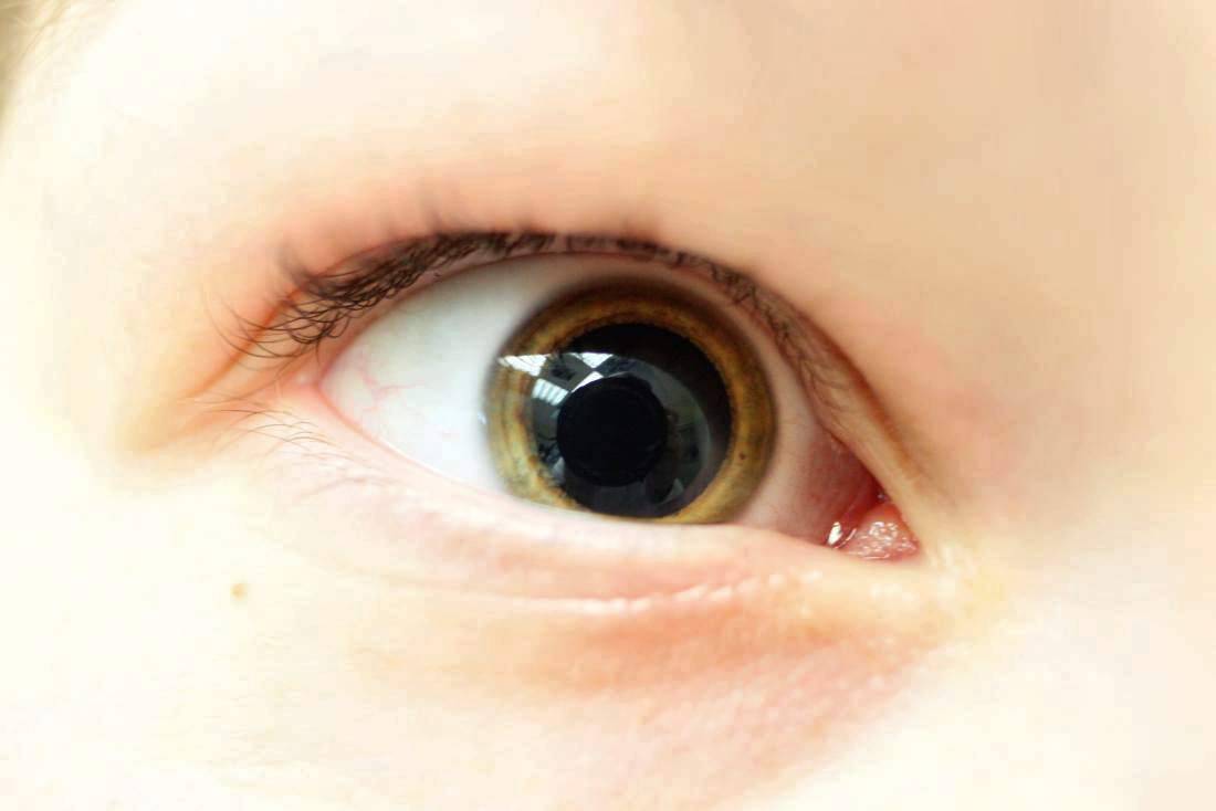 Расширенные зрачки у ребенка: причины, симптомы и методы лечения - "здоровое око"