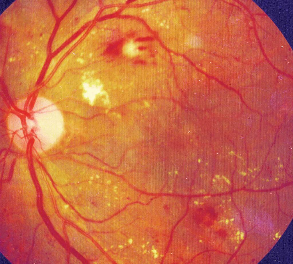 Диабетическая ретинопатия: причины, стадии, симптомы и методы лечения - "здоровое око"