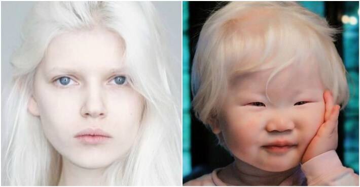 Глазной альбинизм что это описание фото - мед портал tvoiamedkarta.ru