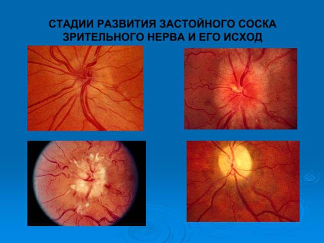 Застойный диск зрительного нерва: причины и лечение