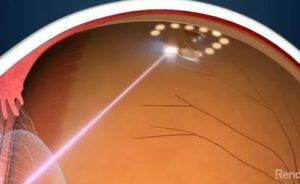Лазерная коагуляция сетчатки глаза