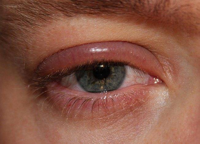 Опухло верхнее веко глаза, что делать: причины отёка над одним глазом, фото, лечение