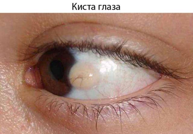 Пингвекула глаза - фото, лечение, причины и симптомы