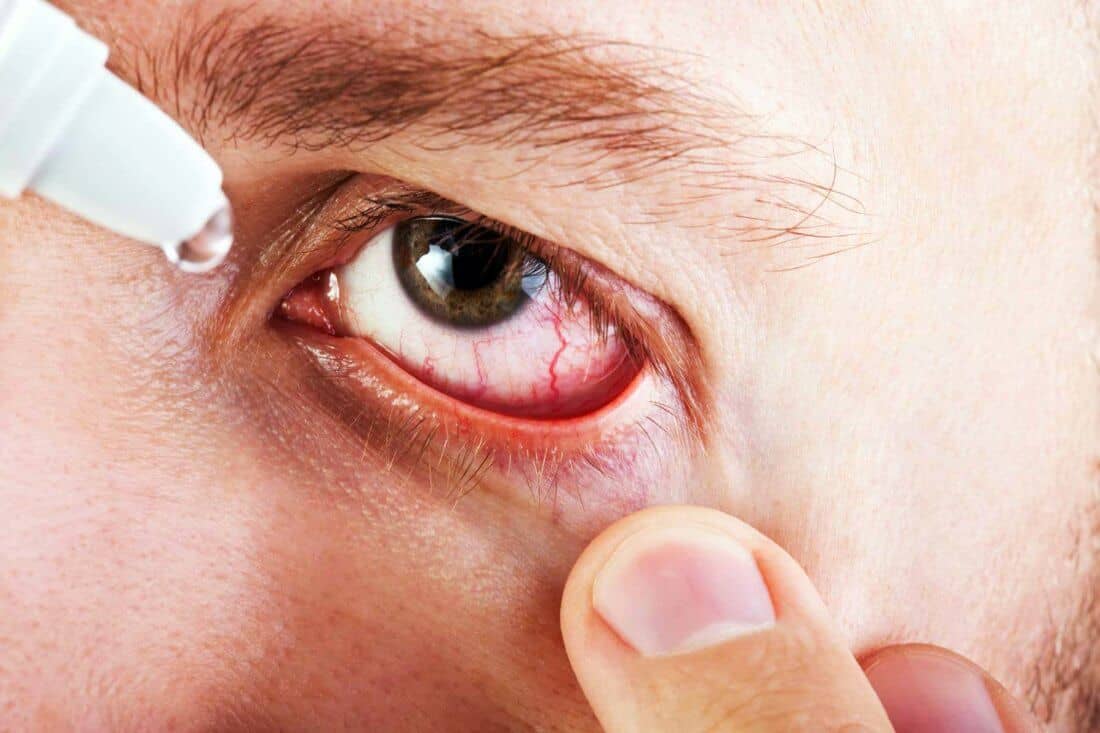 Кровоизлияние в глаз - лечение и причины крови в глазном яблоке