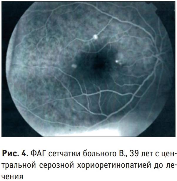 Ангиография глаза