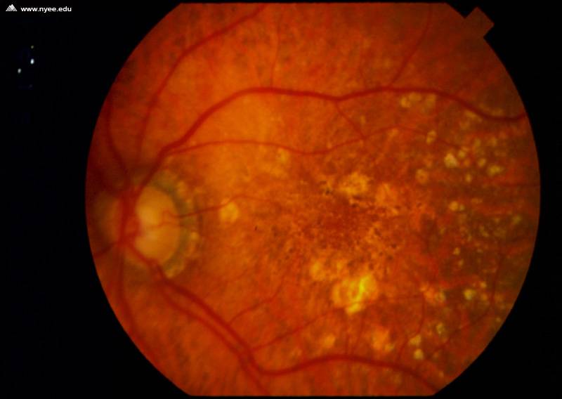 Макулодистрофия сетчатки глаза, причины и симптомы заболевания