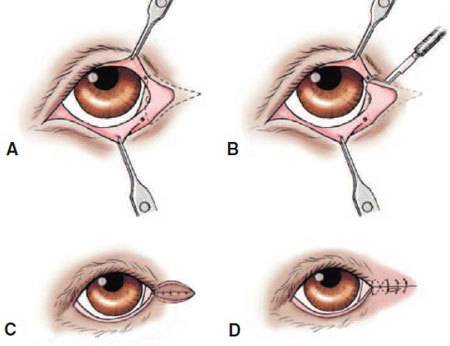 Разрыв глазного яблока - причины, диагностика и лечение