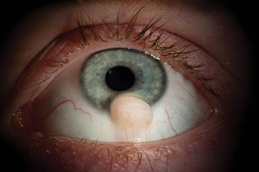 Нарост на глазном яблоке у человека - прозрачный или желтый, причины, как избавиться