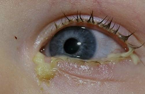 Почему слипаются глаза | пугающие симптомы