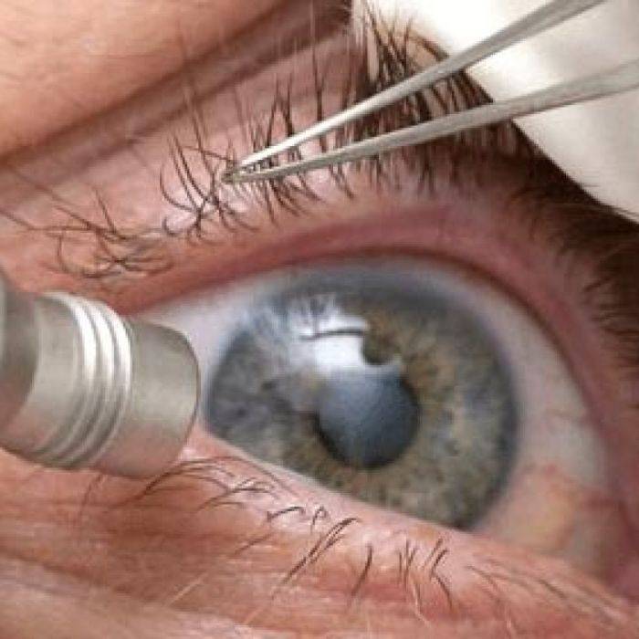 Операции на сетчатке глаза: как проводят при отслойке, разрыве, по укреплению, замена, восстановление после