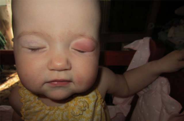 Что делать если у ребенка опухло верхнее или нижнее веко глаза