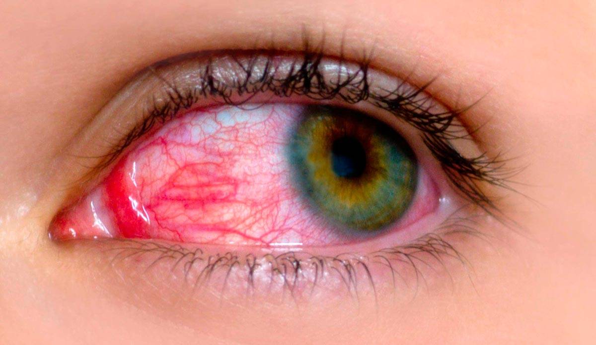 Ожог глаз кварцевой лампой: признаки, первая помощь и лечение