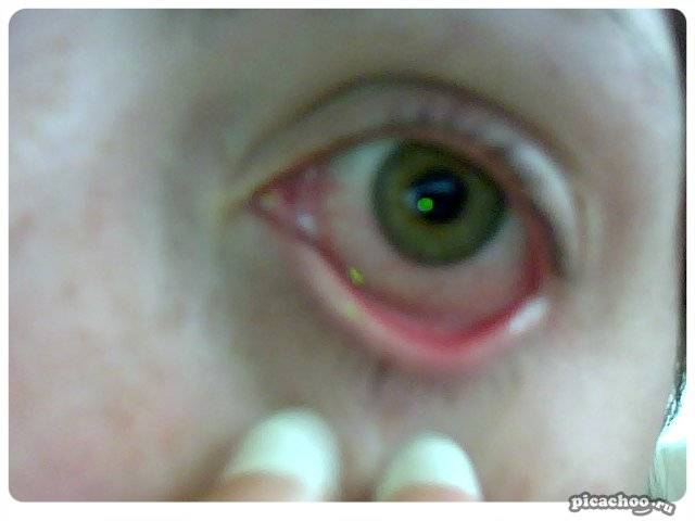 Красные глаза после сна с утра - причины и лечение