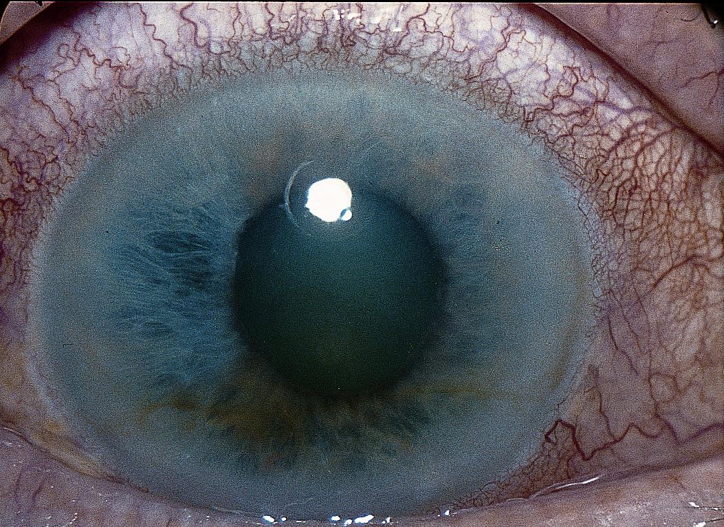 Операция по удалению глаза: как проходит - "здоровое око"