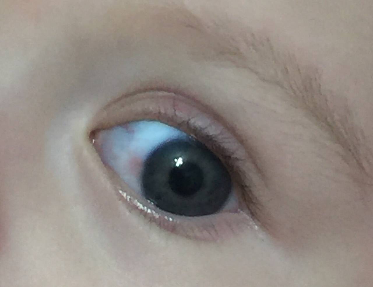 Голубые склеры глаз у ребенка. из-за чего бывают голубыми белки глаз? симптомы, диагностика и лечение