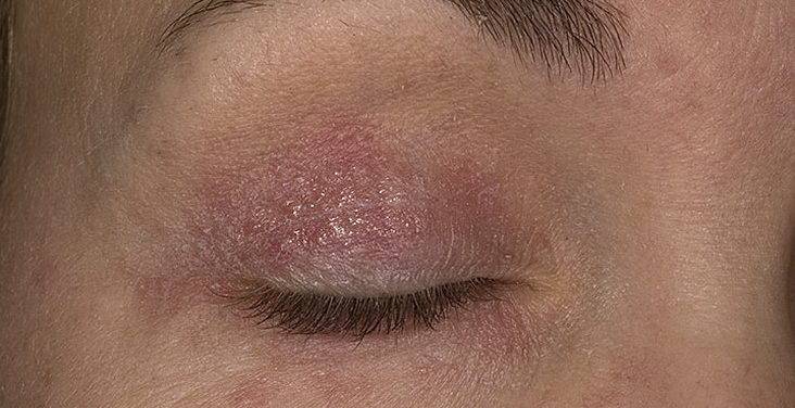 Сухая кожа вокруг глаз и шелушится: причины, лечение в домашних условиях