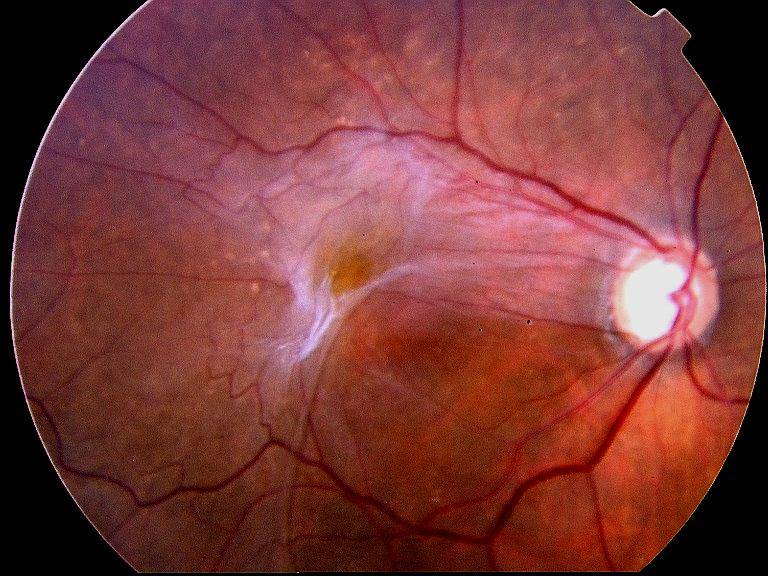 Разрывы и истончения сетчатки глаза: симптомы, причины и лечение