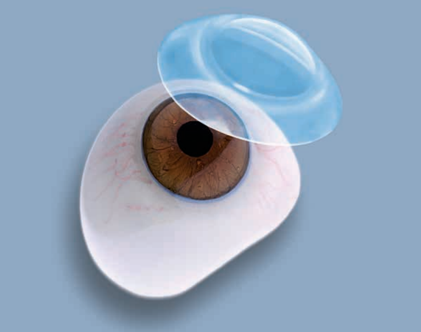 Склеральные линзы для глаз с диоптриями и без - когда можно носить, как одевать ( фото, видео, цена)