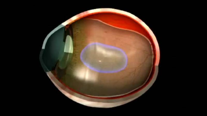 Разрыв сетчатки глаза – причины, симптомы и лечение
