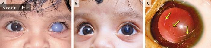 Кровоизлияние в глазу у новорожденного после родов: причины, лечение, профилактика