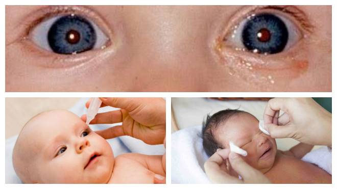 У новорожденного красные глаза после родов: почему меняют цвет белки у грудничка, что делать родителям