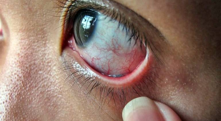 Царапина на роговице глаза - описание, диагностика, лечение болезней и расстройств