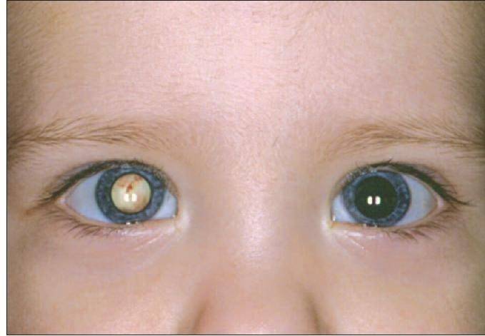 Врожденная катаракта у детей: почему возникает и как распознать патологию у новорожденного ребенка, лечим заболевание правильно