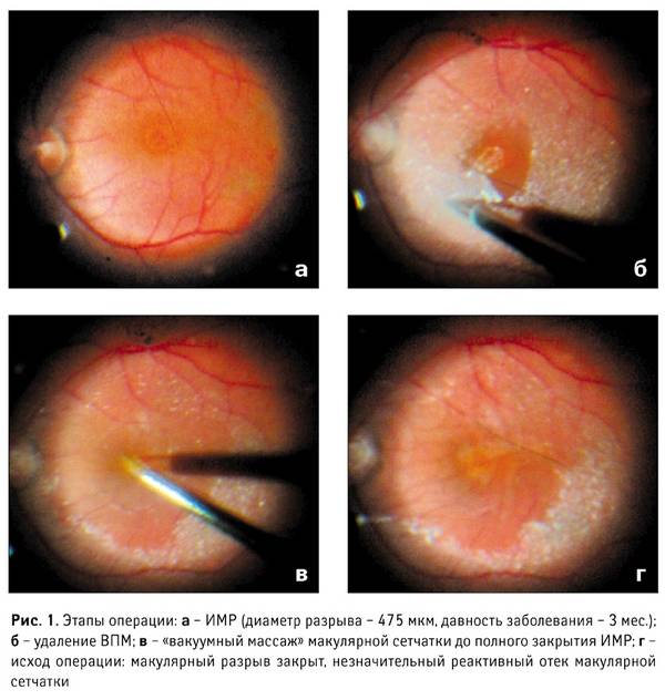 Как проходит операция при макулярном разрыве сетчатки глаза и особенности периода восстановления