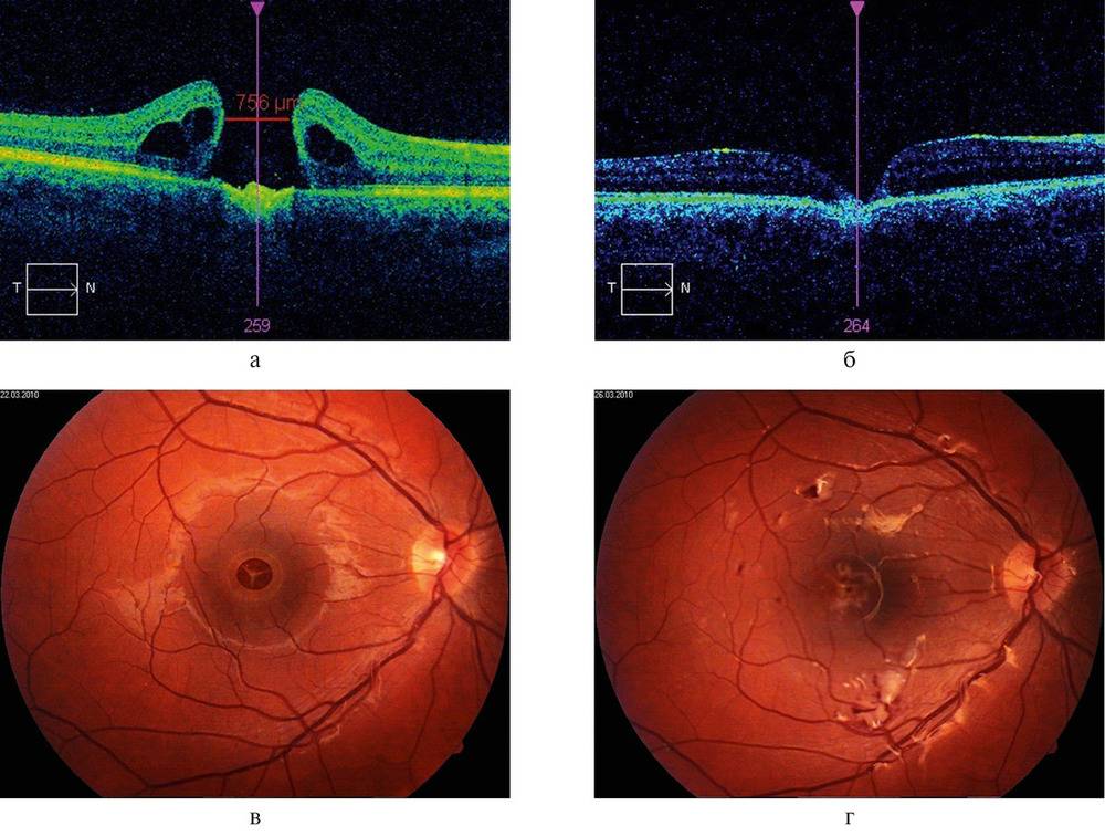 Разрыв сетчатки глаза: причины, симптомы и лечение