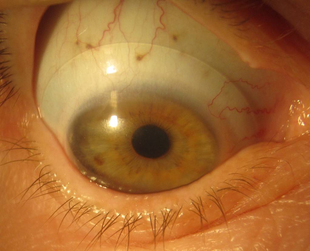 Кератопатия роговицы глаза