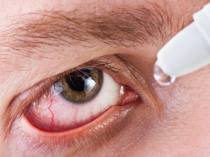 Ожог глаз ультрафиолетовой лампой – что делать, лечение