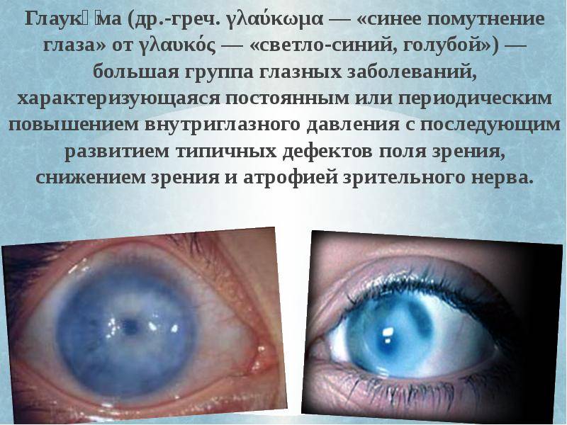 Открытоугольная первичная глаукома. причины, симптомы, диагностика, лечение и профилактика заболевания :: polismed.com