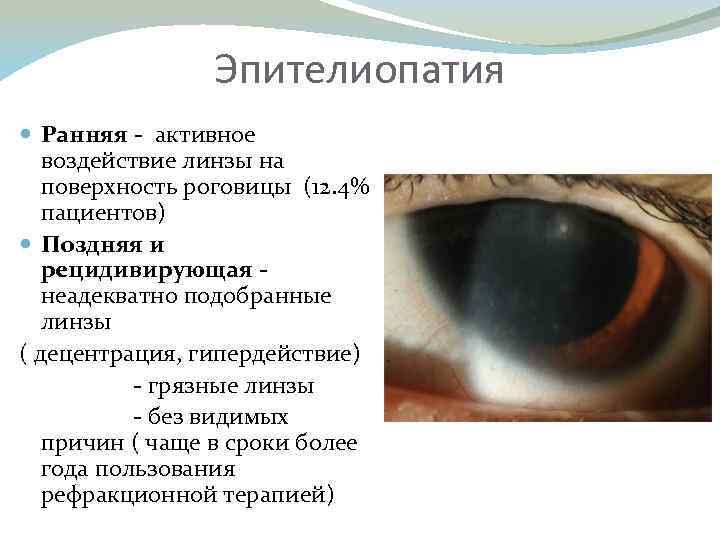 Отслоение роговицы глаза - симптомы, лечение, причины