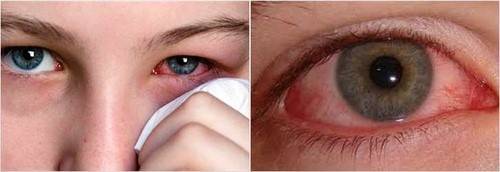 Герпес на глазу (офтальмогерпес) - фото, симптомы, причины, лечение, последствия