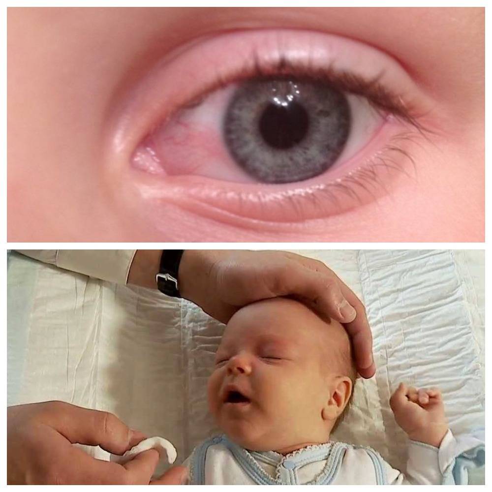 Гнойные заболевания глаз у новорождённых: как бороться с проблемой