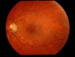 Глазное дно миопический конус. ложная и истинная миопическая стафилома сетчатки глаза. клиническая классификация миопии