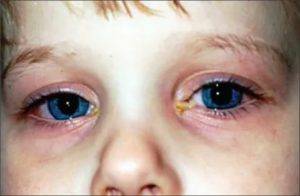 Воспалился глаз у ребенка: возможные причины, лечение